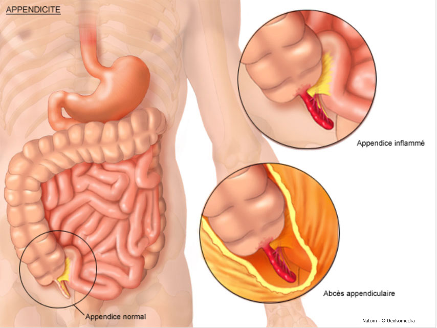 Appendice Inflammatoire